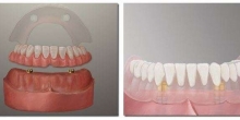 Advantages of Dental Implants