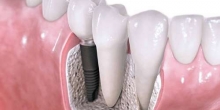 Disadvantages of Dental Implants