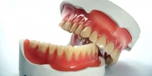 Dental implant Prothesis