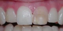 Internal Teeth Bleaching