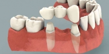 Dental Bridges