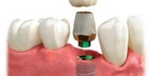 Dental implant cost