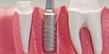 What are dental implants?