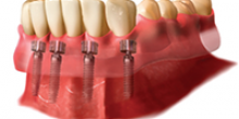  Dental implants 