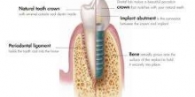 Tek diş eksikliğinde implant