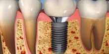 Dental implant