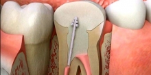 APPLICATON AREAS OF ROOT CANAL TREATMENT