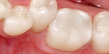 Composite Fillings