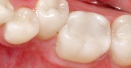 Composite Fillings